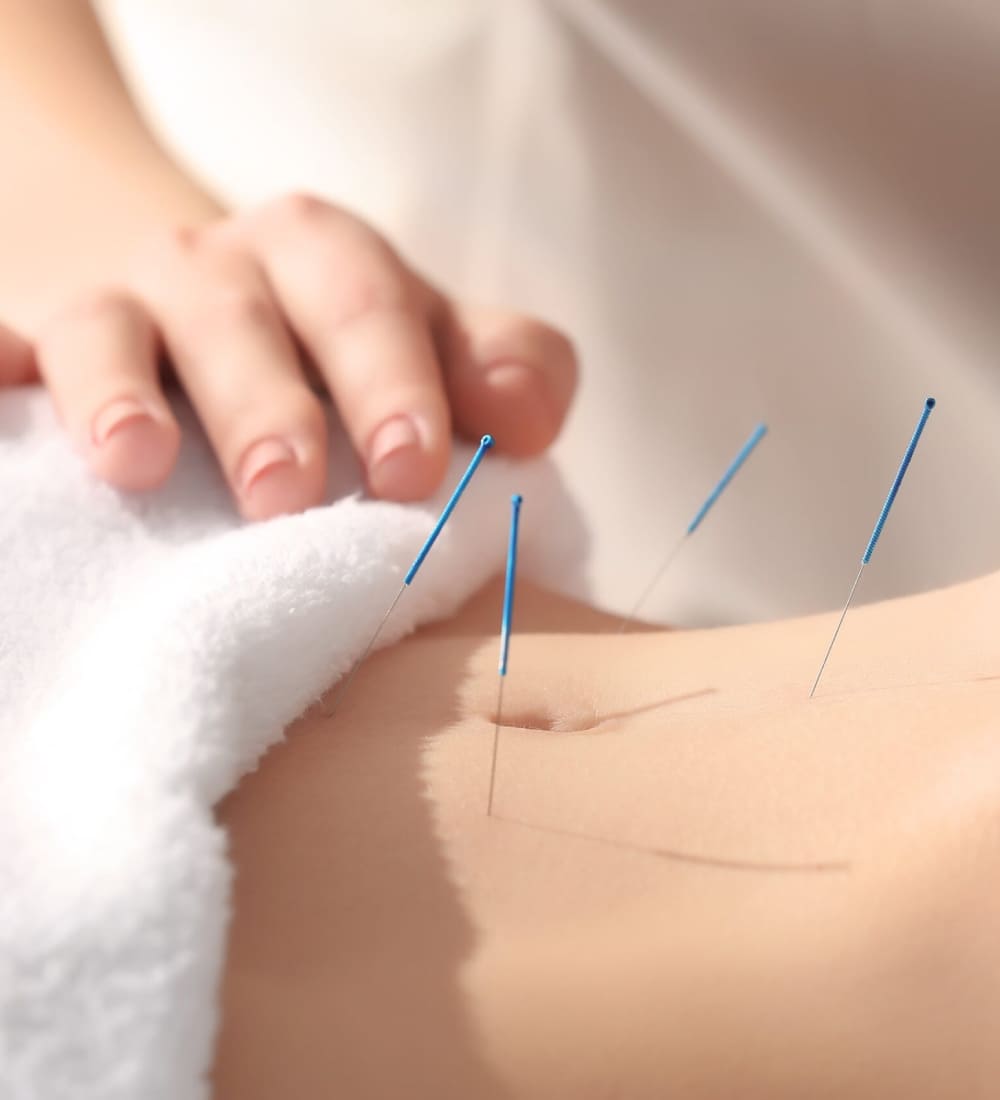 acupuntura-umbilical