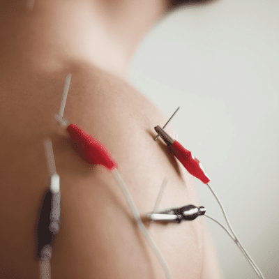 electroacupuntura-400x440-1-400x400